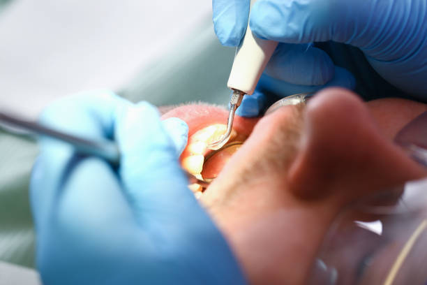 Best Emergency Treatment for Dental Infections or Abscesses in Glenn Dale, MD