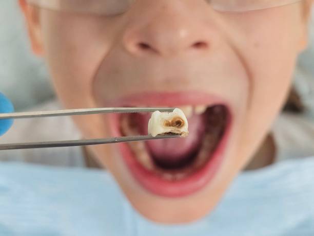 Best Emergency Wisdom Teeth Removal in Glenn Dale, MD