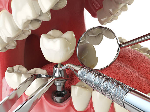 Best Emergency Tooth Extraction in Glenn Dale, MD